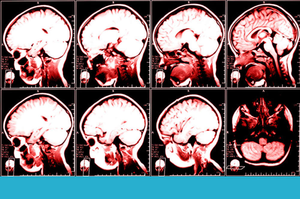 Signs Of Dementia In The Brain