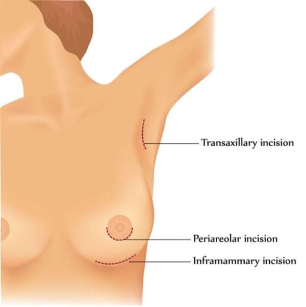 Which Augmentation Incision Area Should I Use?